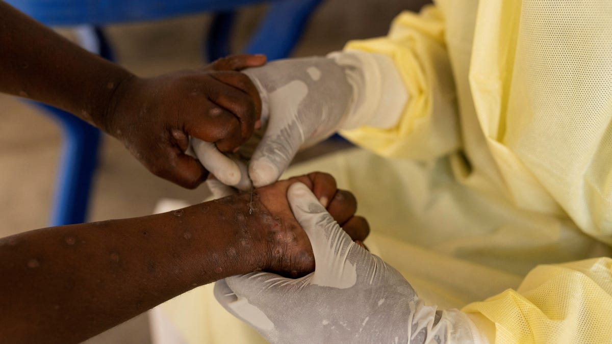 Updates on mpox outbreak: Where it’s been detected and what to do if you get it.