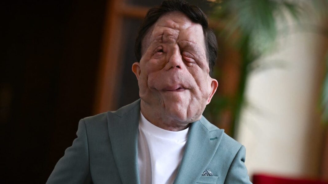 ‘Different Man’ star Adam Pearson once felt ‘undesirable.’ Now, ‘I’m undisputable.’