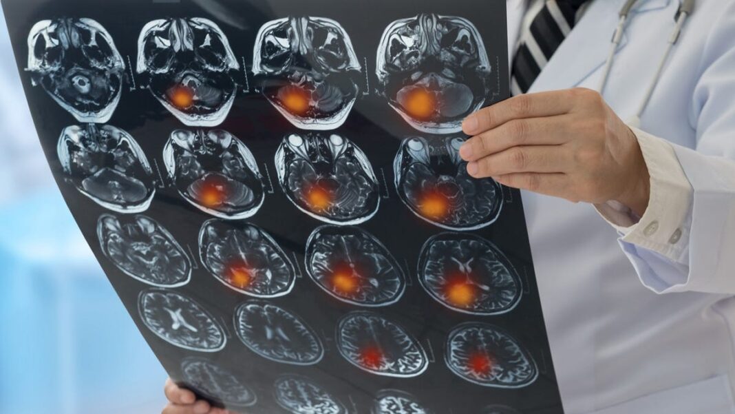 New guidance for stroke prevention includes Ozempic, other weight loss drugs