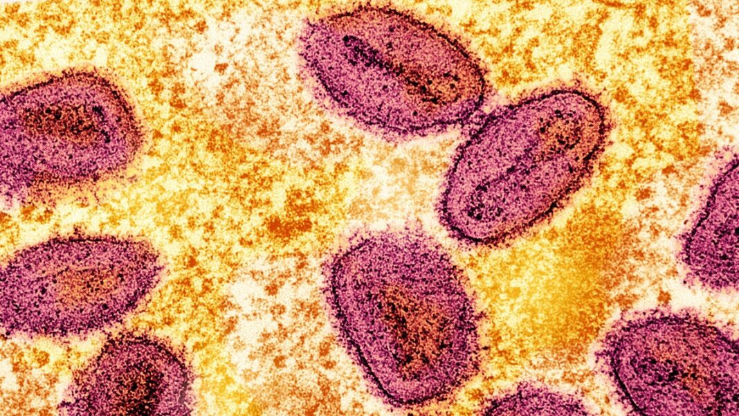 Mpox strain identified for first time in US, health officials say