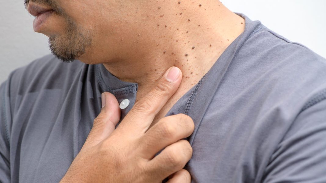 What exactly causes skin tags? Here’s what dermatologists have to say.